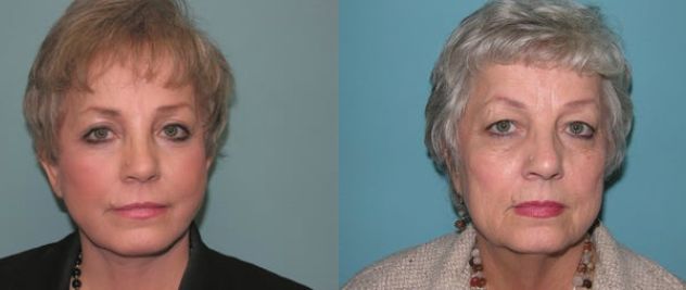 ⁨صور عملية شد الوجه جراحياً قبل وبعد ٧