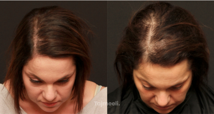 صور قبل وبعد فيلر الشعر | تجارب حقيقية والنتائج | تجميلي