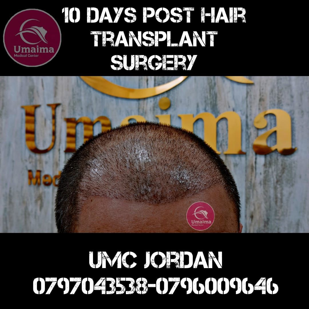 10 days post hair transplant surgery مركز أميمة