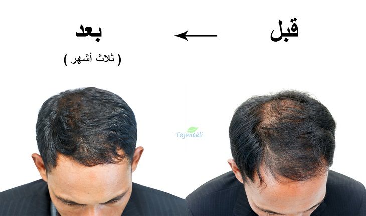 أين يمكنك زراعة الشعر الطبيعي بالمغرب