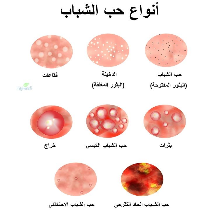 حب الشباب الكيسي