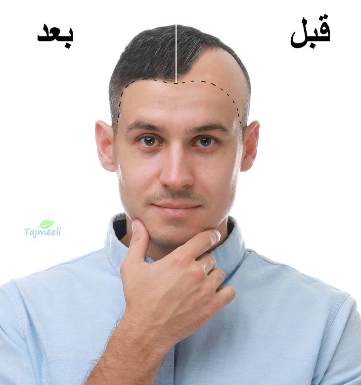 زراعة الشعر بدون جراحة في دبي
