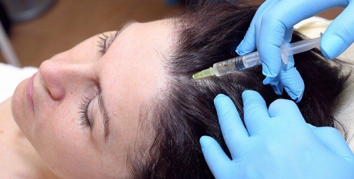 علاج تساقط الشعر عن طريق الوخز بالإبر الدقيقة