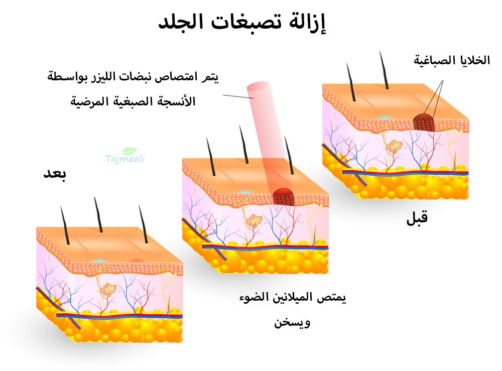 عمليات الليزر لازالة التصبغات الجلدية