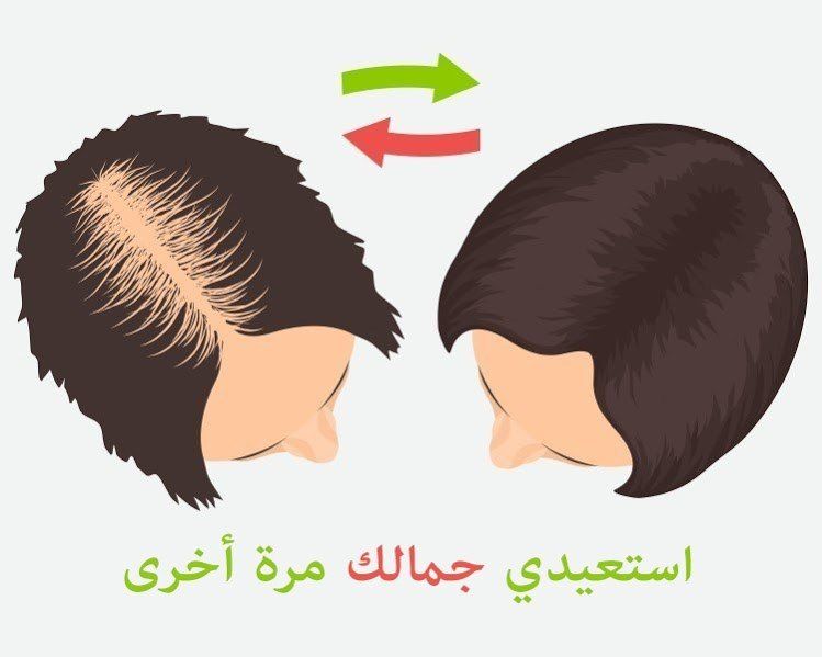 ما بعد عملية زراعة الشعر