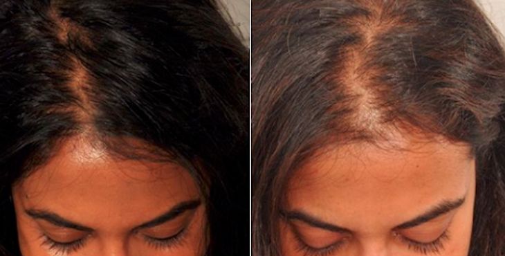 مميزات علاج تساقط الشعر في مصر