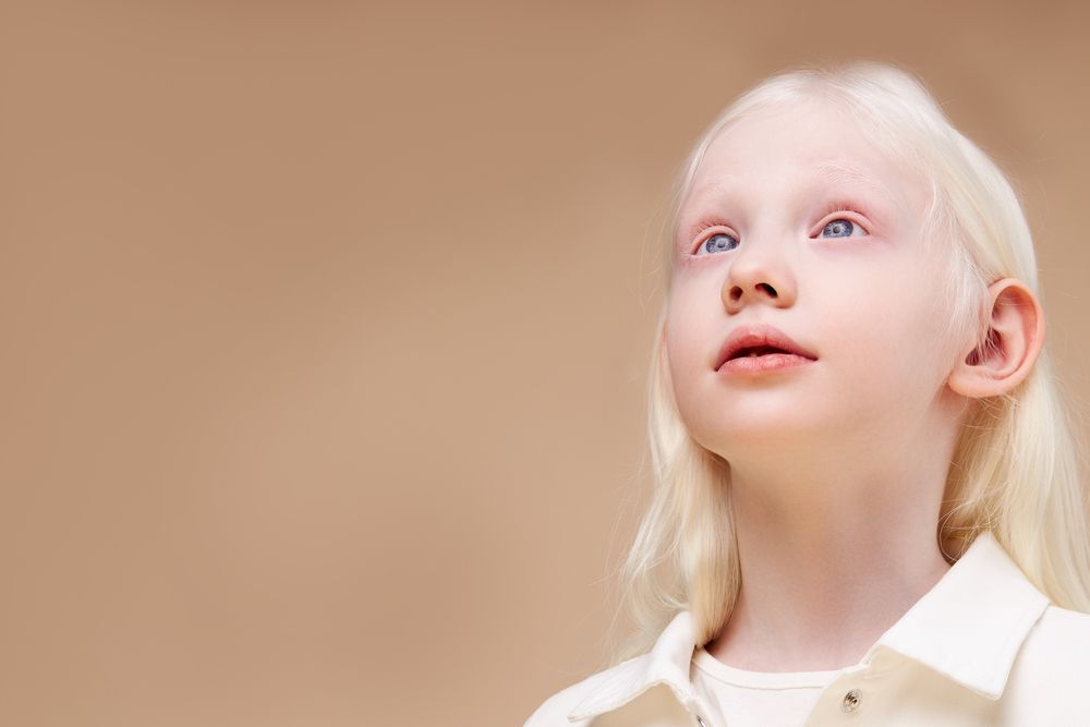 المهق أو البرص (Albinism)