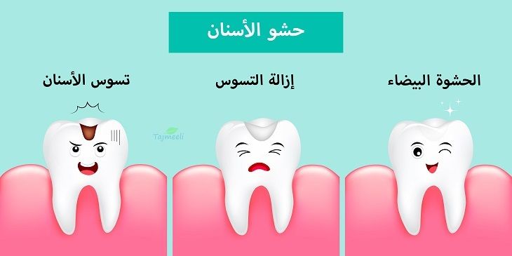 حشو الأسنان بالليزر في السعودية