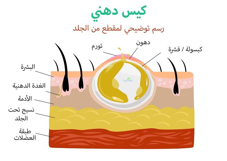 علاج الكيس الدهني في مصر