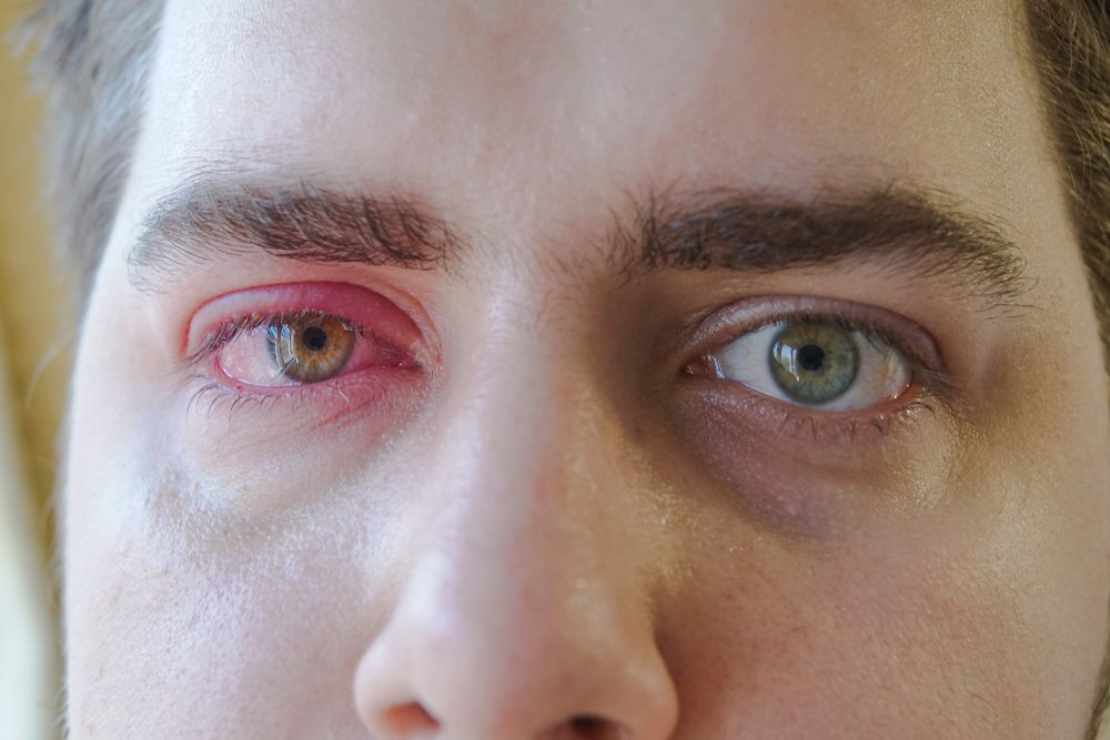 عوامل الخطورة للإصابة بالكيس الدهني بالعين