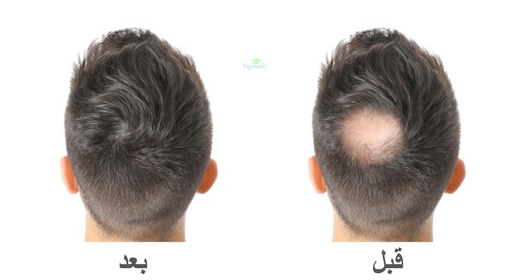 نتائج زراعة الشعر