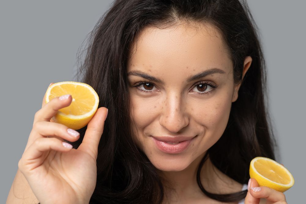 وصفة قشور البرتقال والليمون لعلاج الكلف