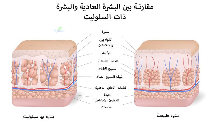 ⁨‎⁨مقارنة للبشرة العادية والجلد السيلوليت