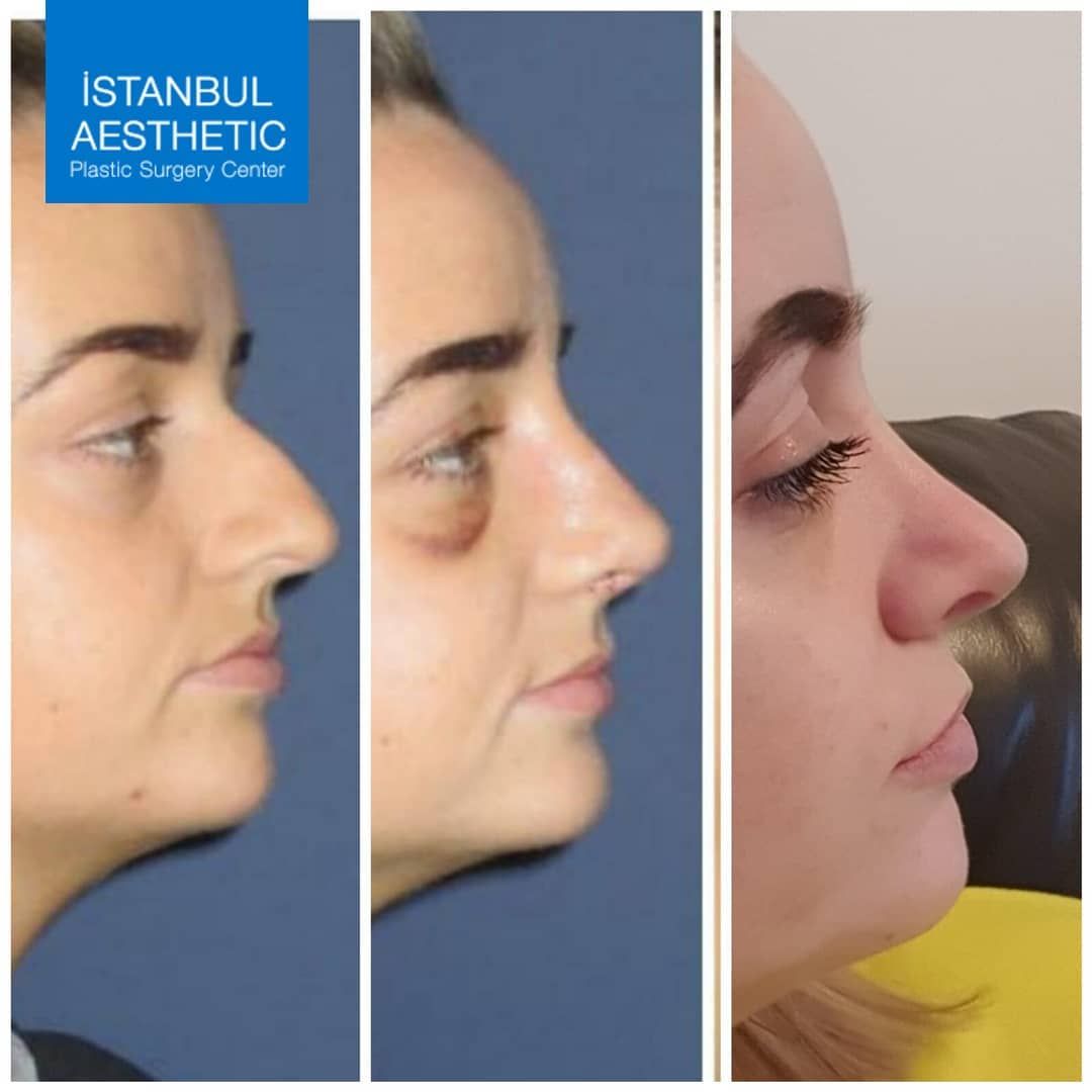 5th month results of a nose job.