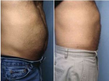 Liposuction شفط الدهون في تونس