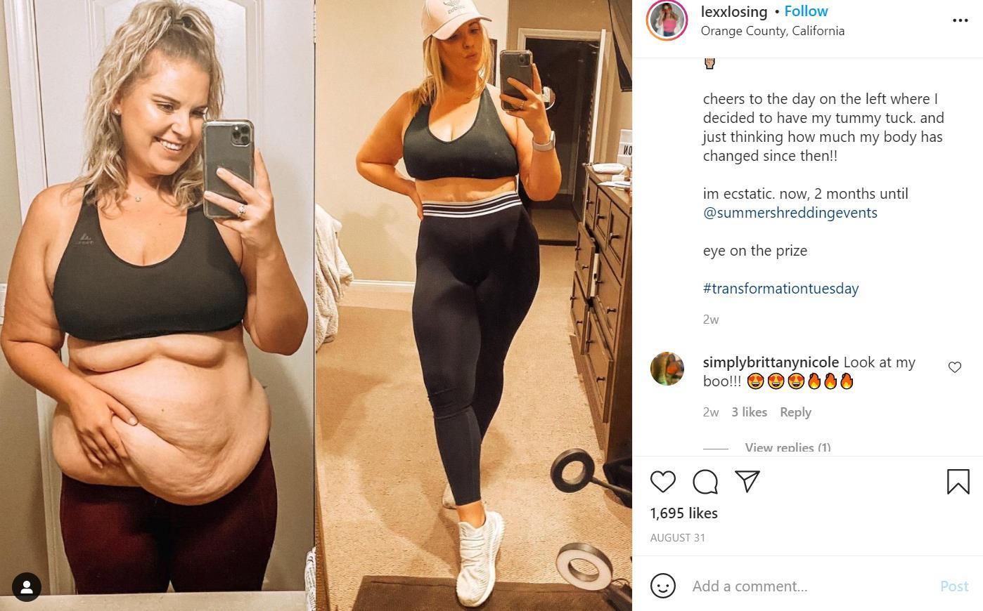 instagram gastric sleeve before after 3
