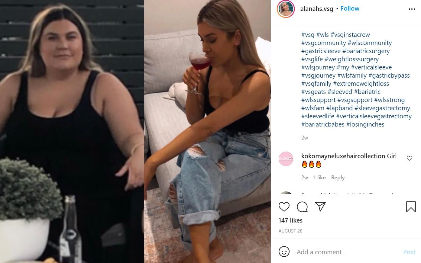 instagram gastric sleeve before after