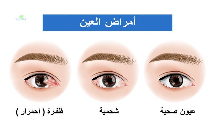 أمراض العين
