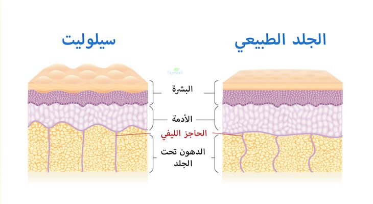 ⁨‎⁨الفرق بين الجلد المشدود والسيلوليت ⁩⁩