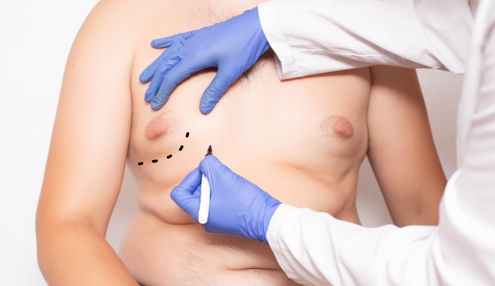 ⁨‎⁨جراحة إزالة أنسجة الثدي  لعلاج التثدي عندالرجال⁩⁩