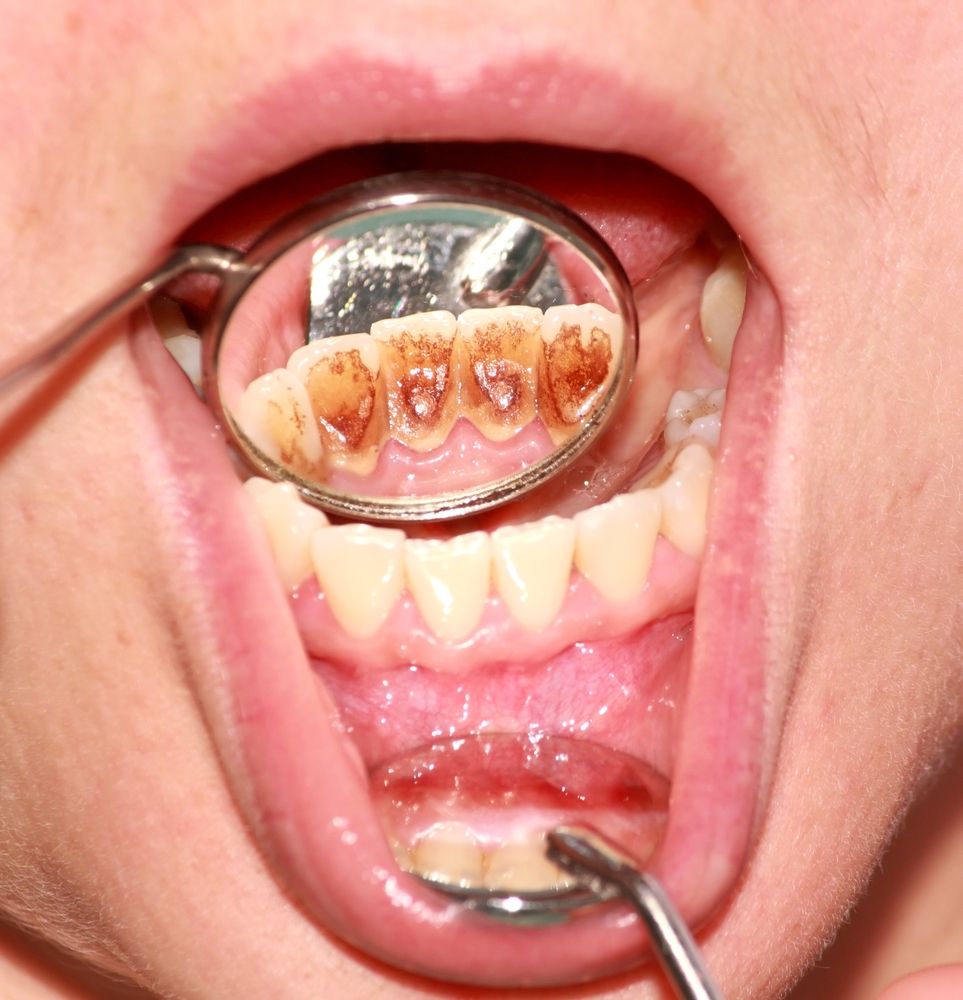 ما أضرار جير الأسنان المتراكم؟