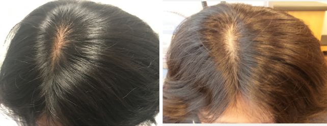 ⁨‎⁨نتائج استخدام كريمات الشعر لعلاج التساقط⁩⁩