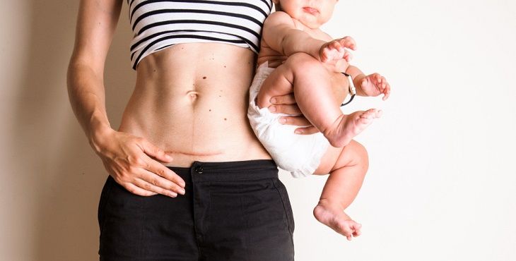 متى يمكن استخدام حزام البطن بعد الولادة؟