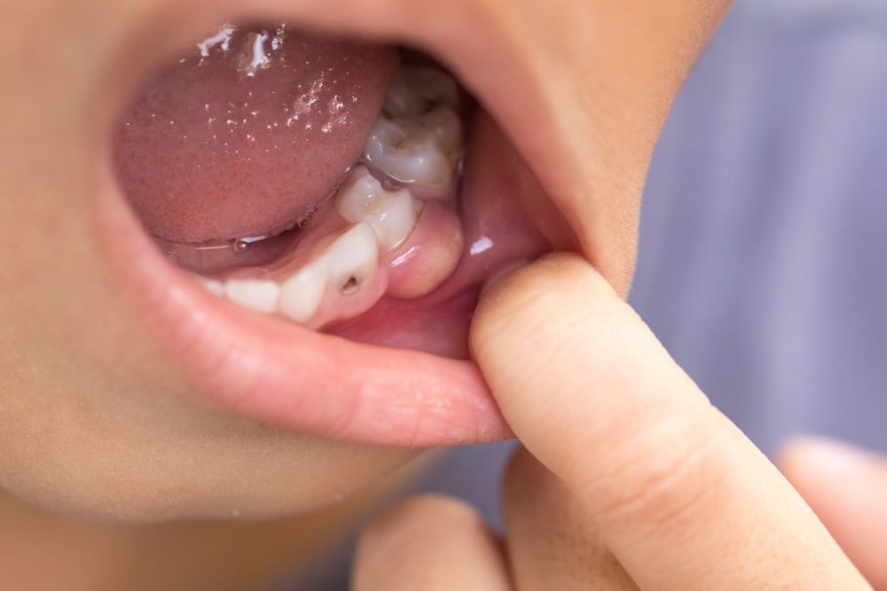أسباب حدوث خراج الأسنان