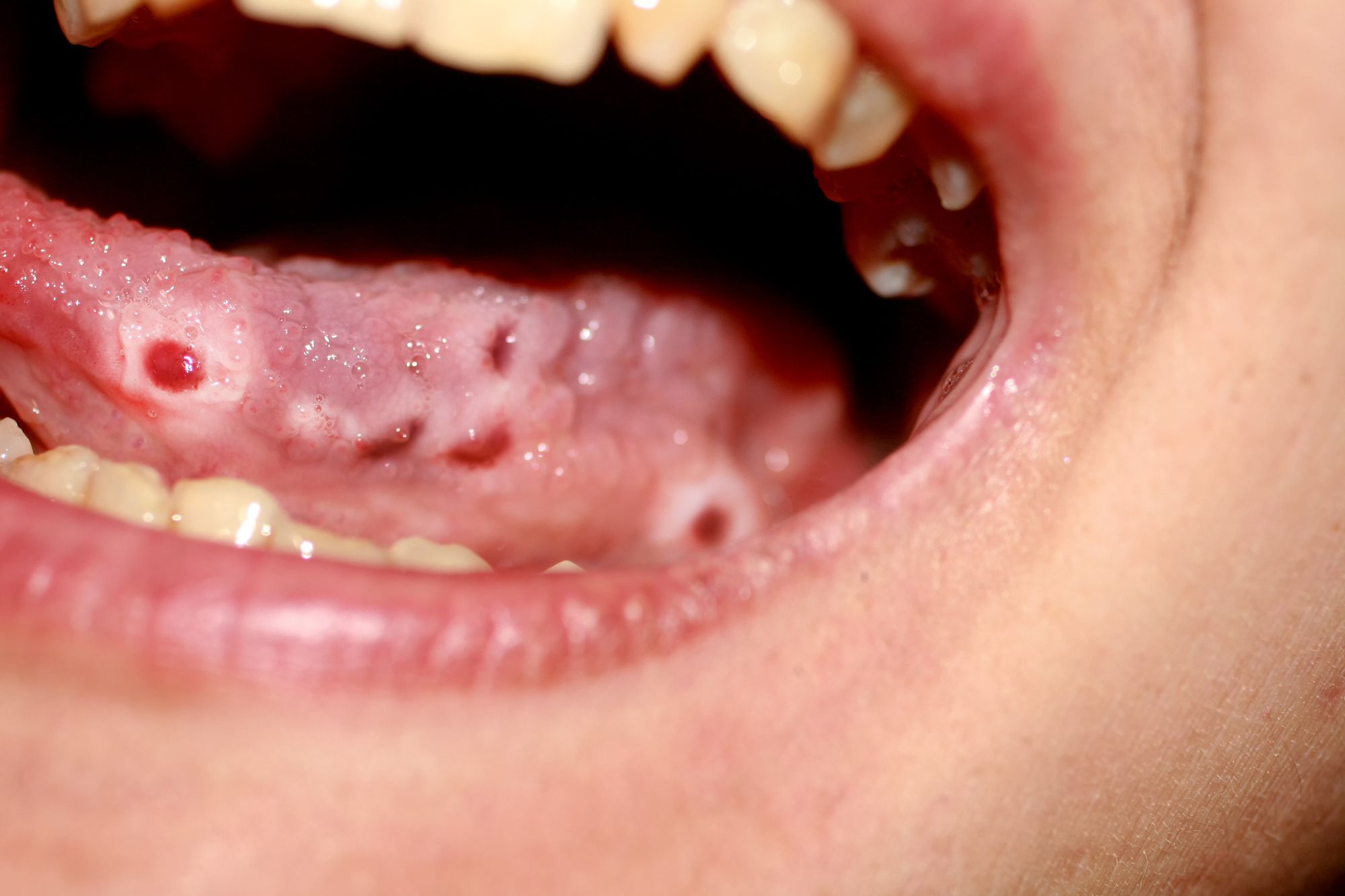 أعراض فطريات الفم واللسان