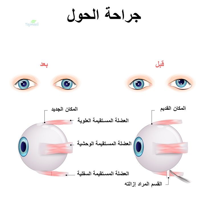 أنواع انحراف العين وجراحة الحول