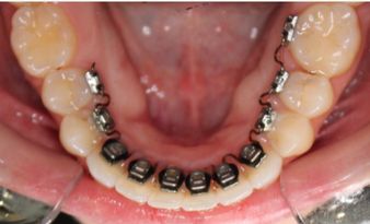 التقويم اللساني أو التقويم المخفي lingual teeth braces