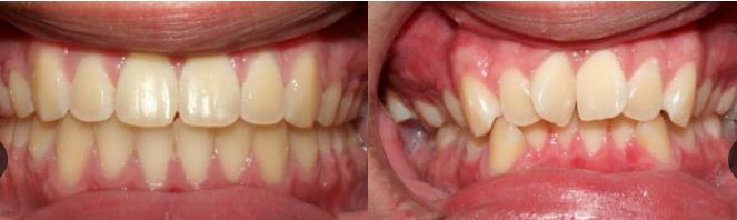 خراج الأسنان بعد علاجه