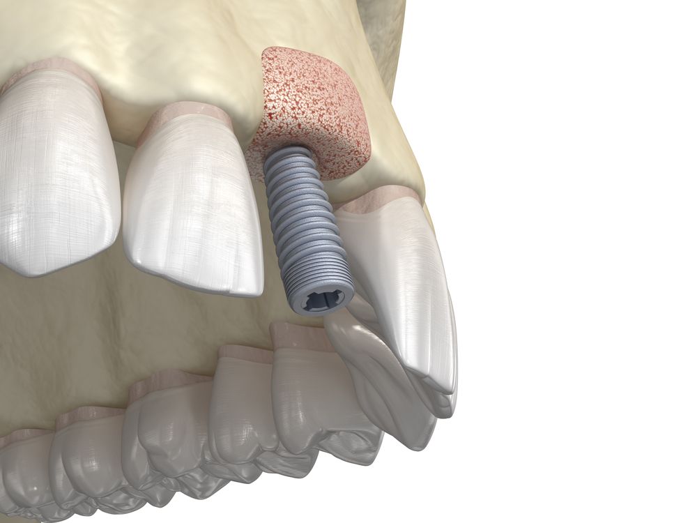 زراعة عظام الفك لتثبيت الأسنان