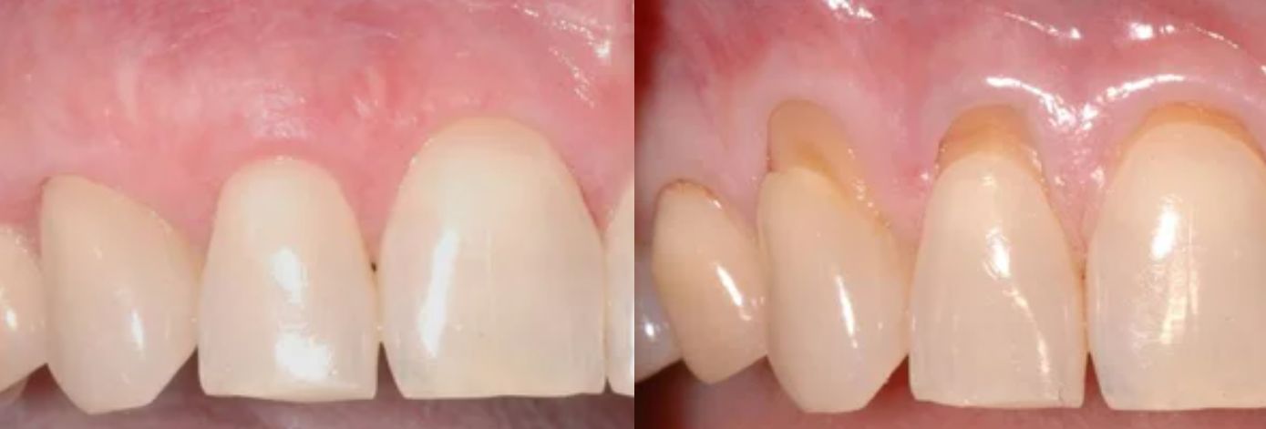 علاج التهاب اللثة والأسنان قبل وبعد