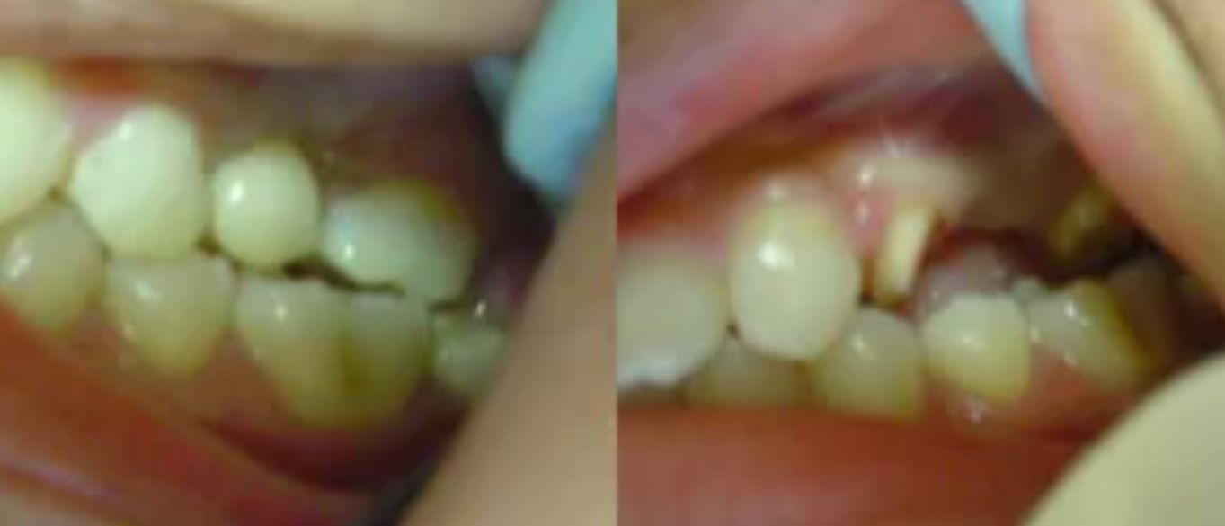 علاج خراج الأسنان قبل وبعد