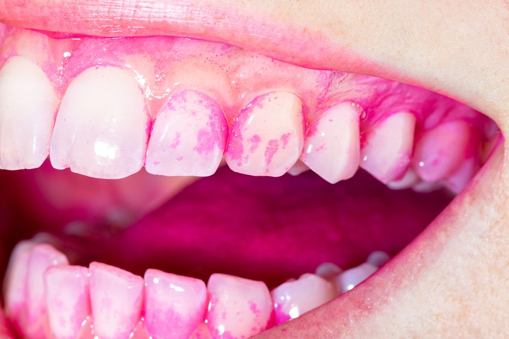 علاج موضعي لعلاج التهاب اللثة والأسنان