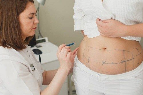 ⁨‎⁨عملية شفط الدهون في البطن⁩⁩