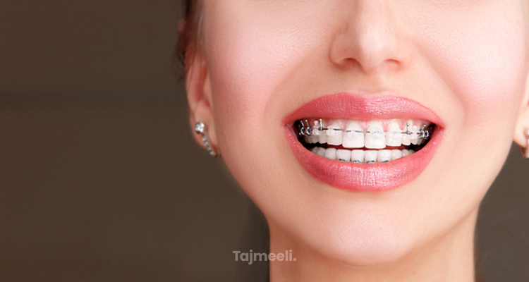 ⁨‎⁨ما هي مدة تقويم الاسنان لأسنان جميلة بدون فراغات⁩⁩