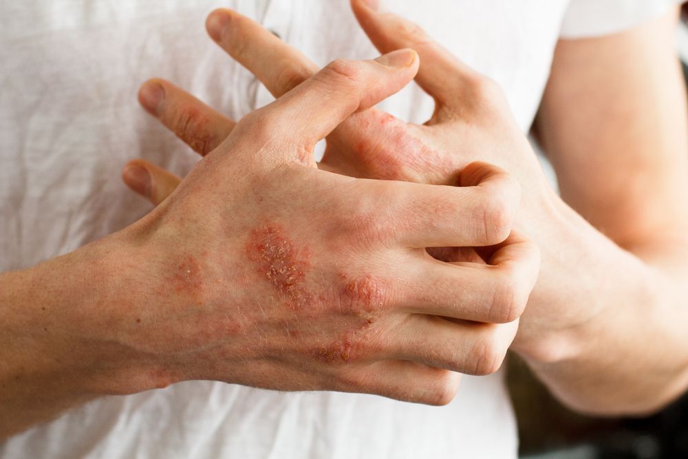 يعالج زيت الأركان العديد من الأمراض الجلدية