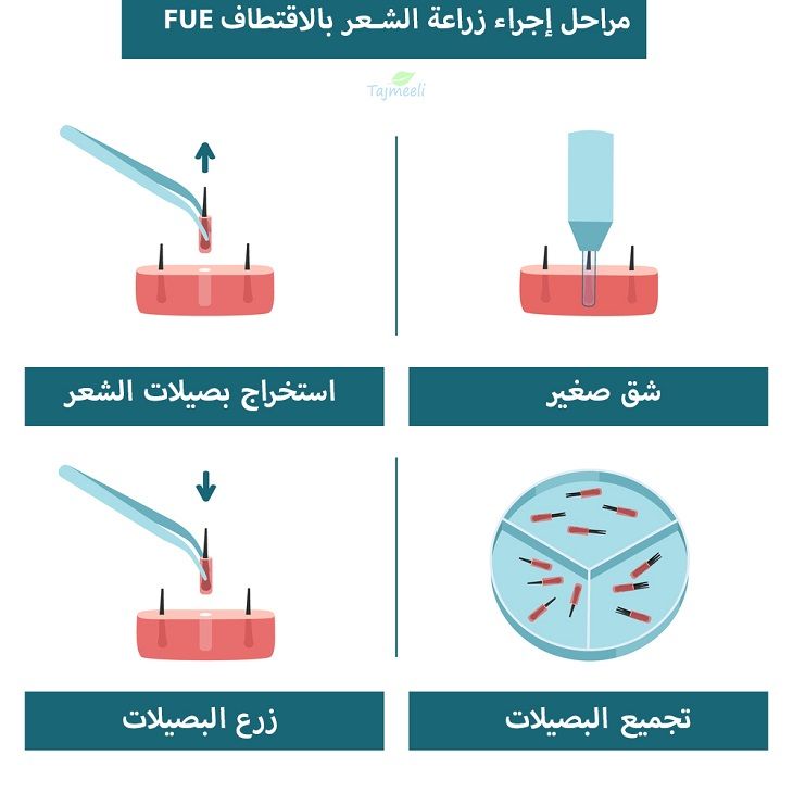 زراعة الشعر بالتقسيط في السعودية الاقتطاف والشريحة تجميلي