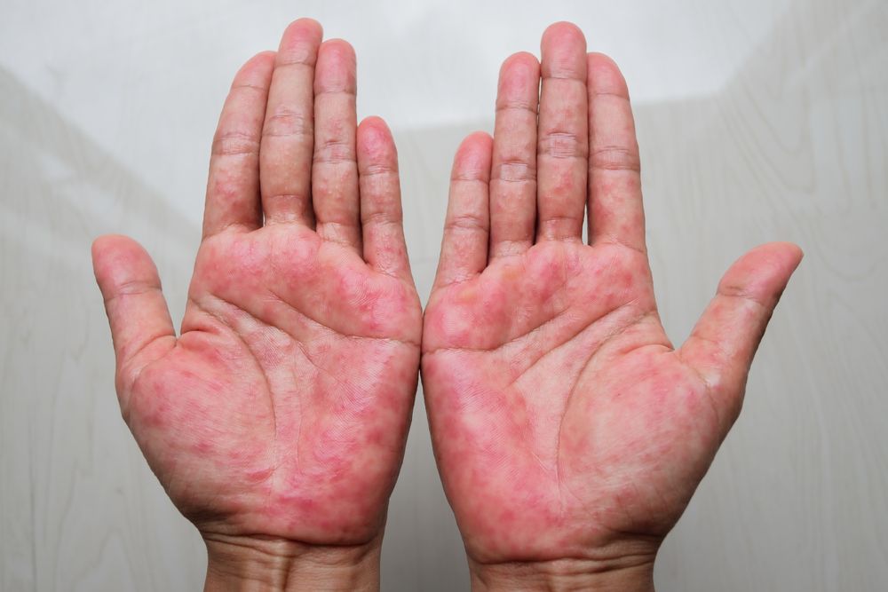 ⁨‎⁨أكزيما اليد (Hand eczema)⁩.