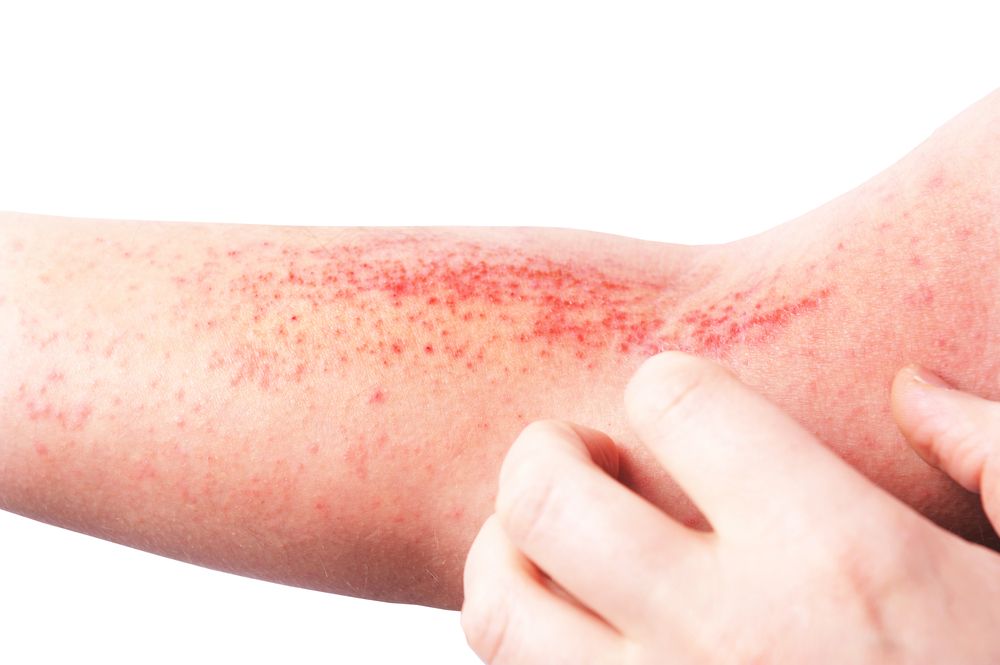 ⁨‎⁨التهاب الجلد التماسي (Contact dermatitis)⁩