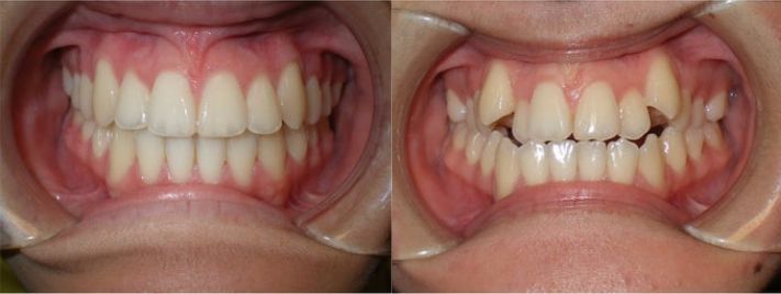 الحالات التي تصلح لعمل تقويم الأسنان 
