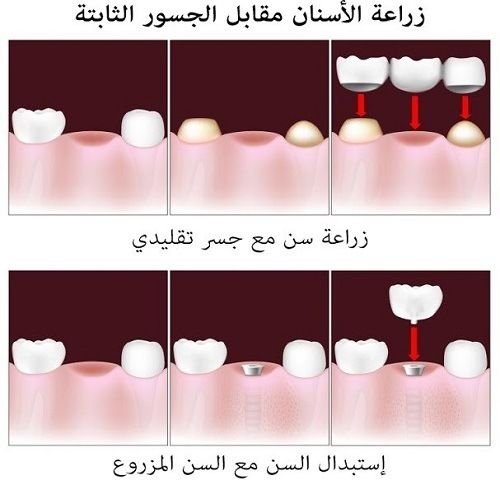 الفرق بين زراعة الأسنان وجسور الأسنان
