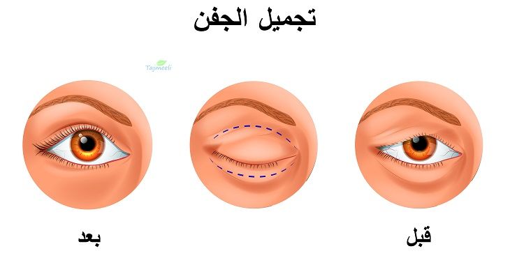 تقنية تجميل العيون في إيران
