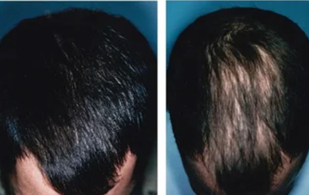 علاج تساقط الشعر باستخدام زيت الخردل