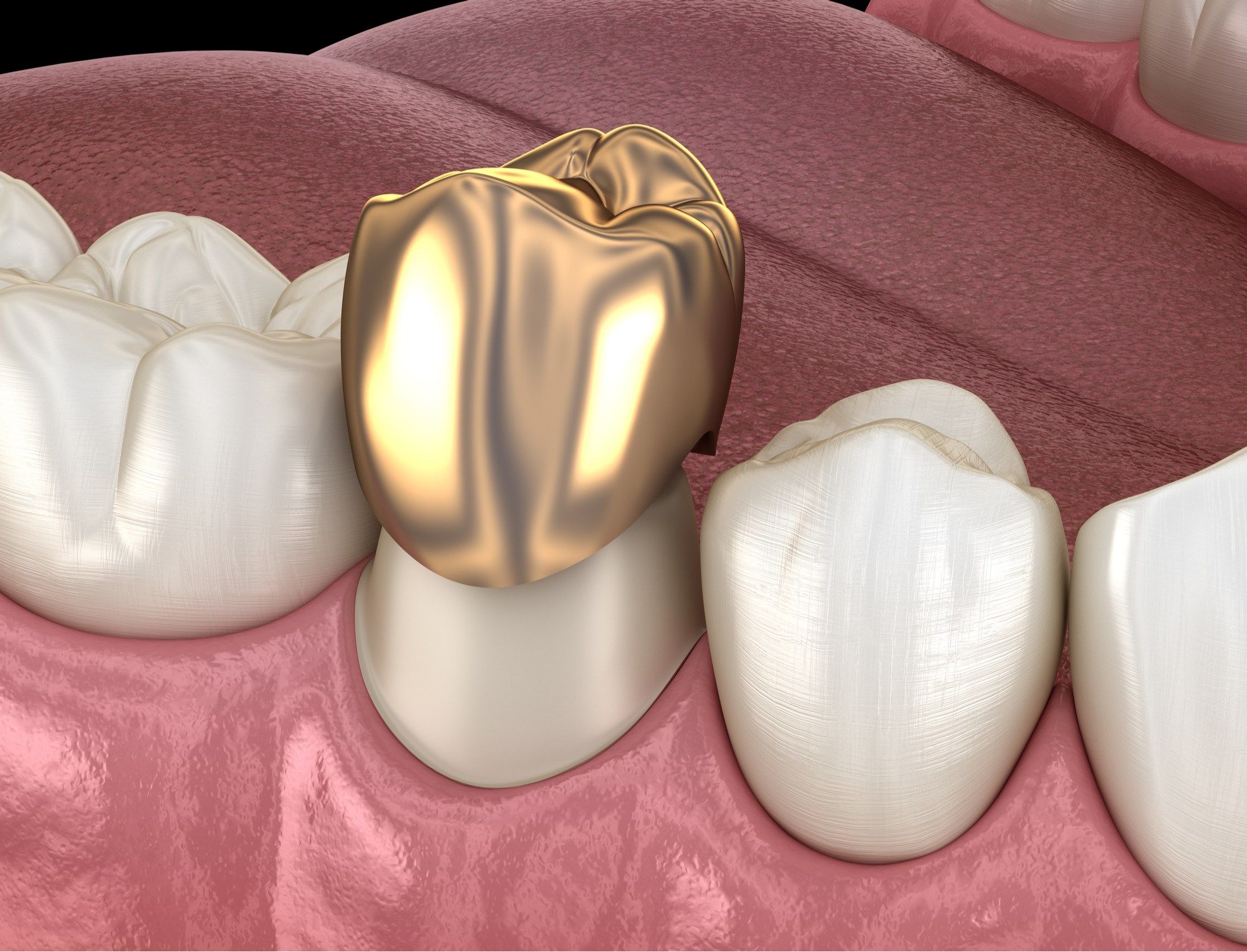 ما هي أهم أنواع تركيبات الأسنان؟