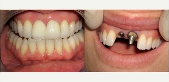 ⁨‎⁨نتائج زراعة الأسنان بالمهديب⁩⁩