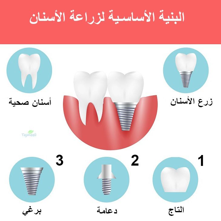 ما يجب أن تعرفه عن زراعة الأسنان في سلطنة عمان