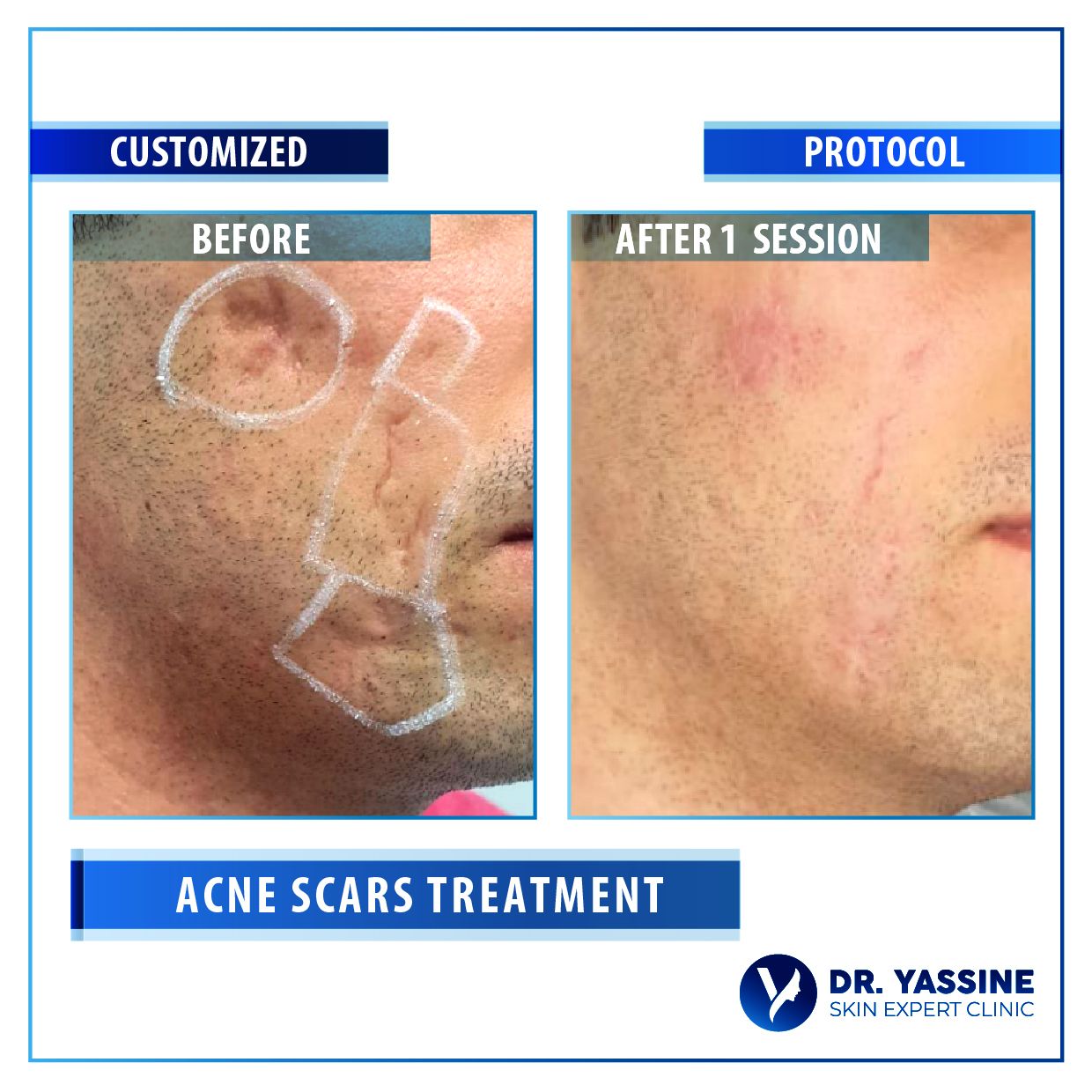 Acne Scars Treatment-01